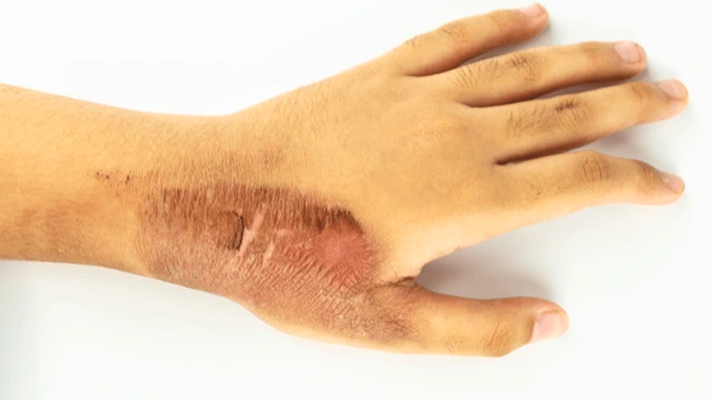 Burn Scar